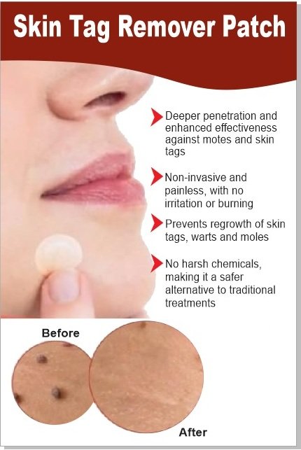 Derma Smooth Skin Tag Removal Patches (Pack Of 10)